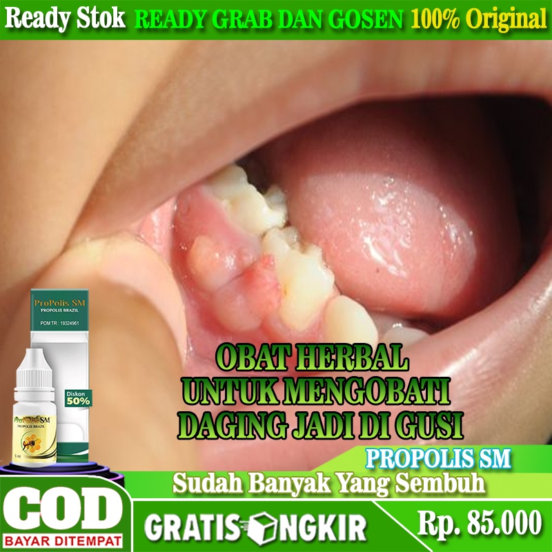 Jual Obat Penghilang Daging Jadi Di Gusi, Obat Penghilang Daging Tumbuh