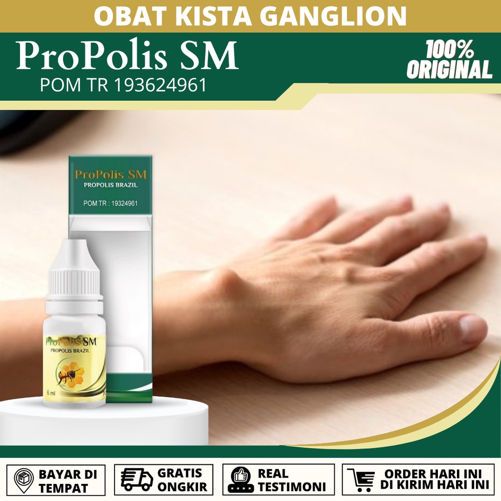 Jual Obat Kista Ganglion Di Tangan, Ganglion Benjolan Di Tangan, Kista ...