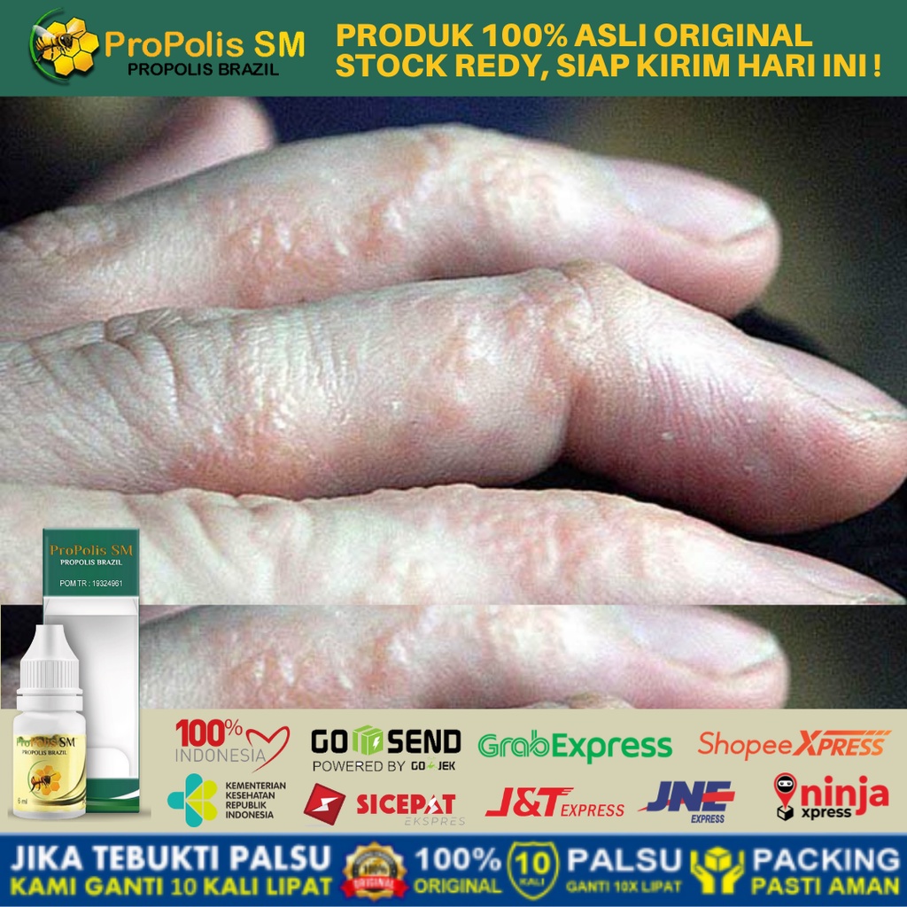 Jual Obat Gatal Berair Di Jari Tangan Dan Kaki Obat Bintik Bening