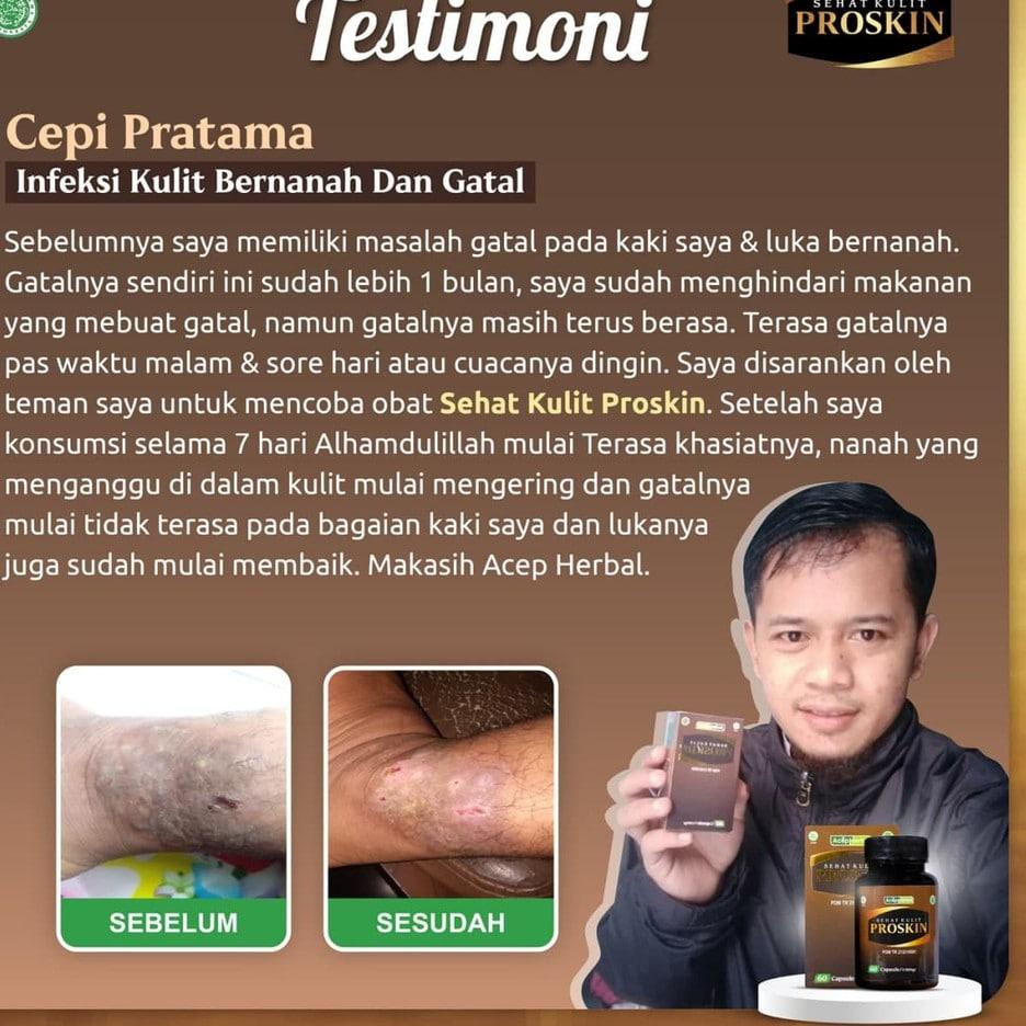 Jual Kekinian Obat Gatal Di Badan Gatal Seluruh Badan Gatal Pada