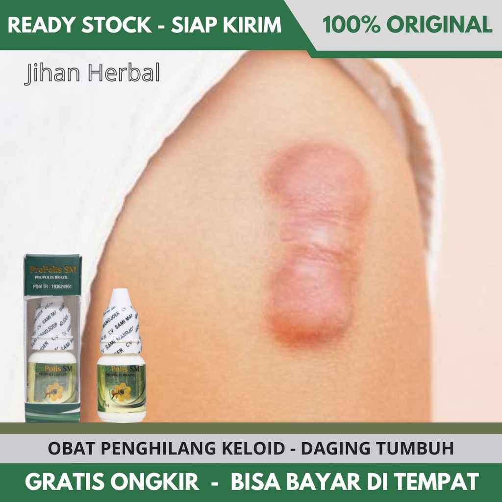 Jual Obat Keloid Daging Tumbuh Penghilang Keloid Menahun Keloid Bekas