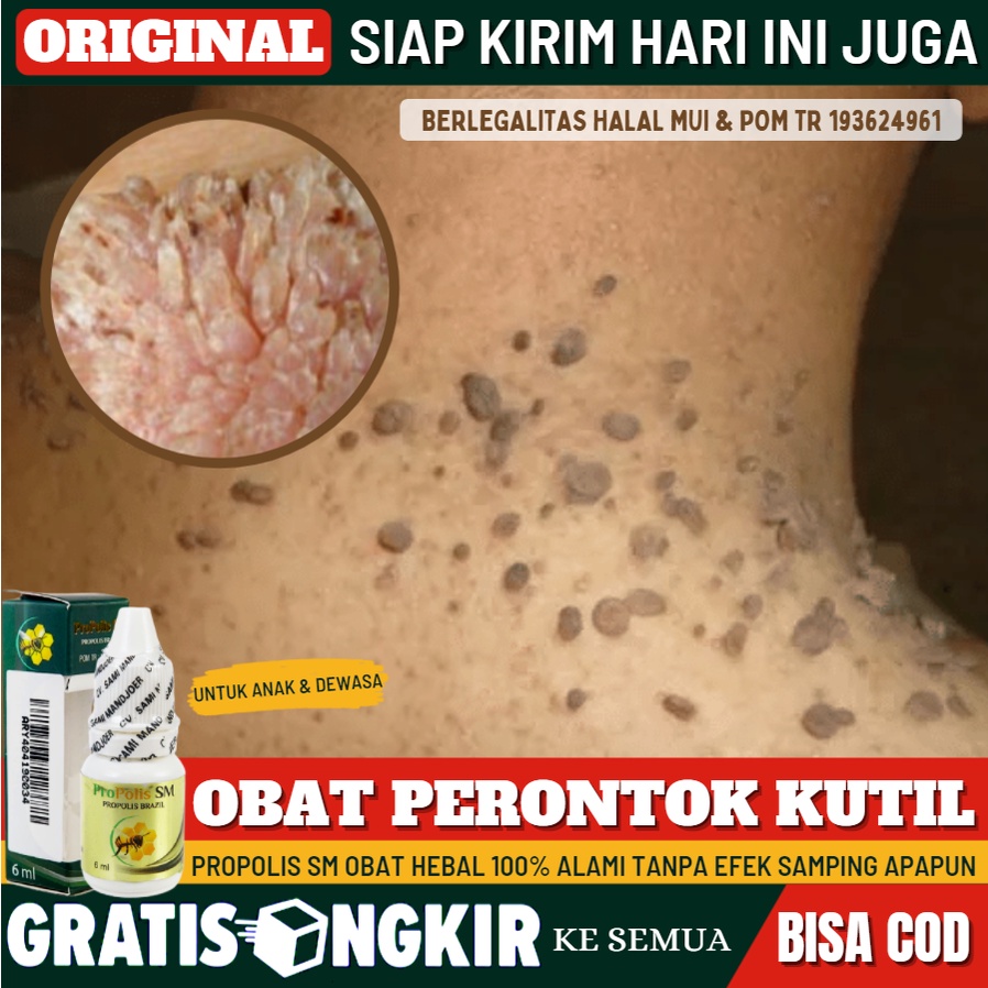 Jual Obat Daging Tumbuh, Obat Oles Penghilang Daging Jadi  Skintag Secara  Alami, Perontok Kutil  Mata Ikan  Skin Tag  Daging Jadi  Jengger Ayam   Kutilan  Keloid, Obat