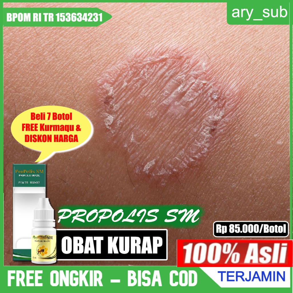 Jual Obat Kurap Propolis Obat Kulit Gatal Gatal Panu Kadas Kurap Kutu Air Herbal