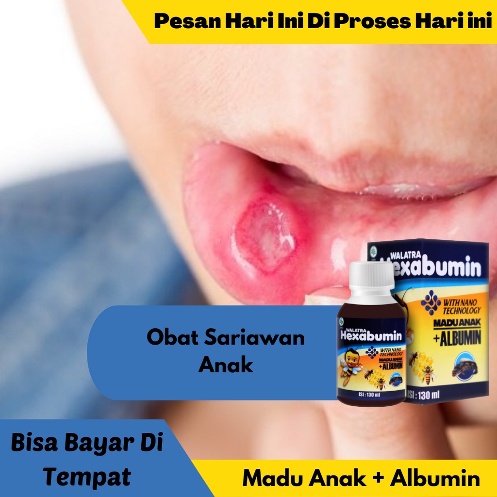 Jual Obat Sariawan Anak , Lidah Sariawan , Sariawan Anak Susah Makan ...