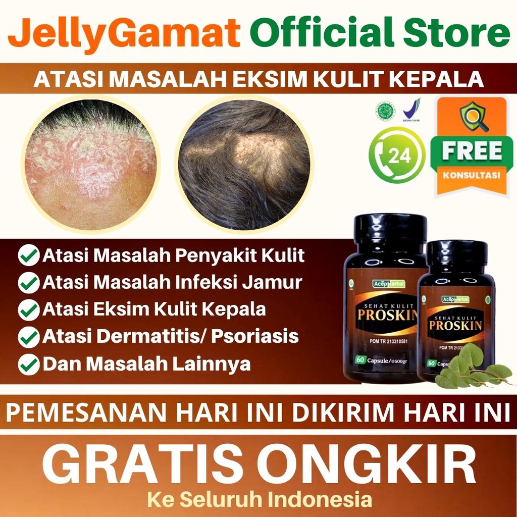 Jual Obat Eksim Kulit Kepala Kulit Infeksi Jamur Kulit Kepala Kepala