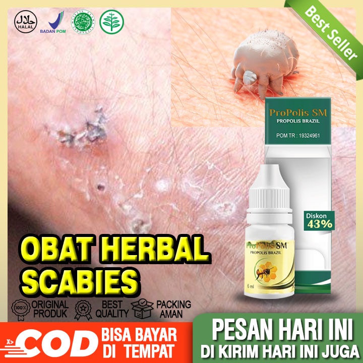 Jual Obat Scabies Obat Scabies Alami Penyakit Kulit Scabies Scabies