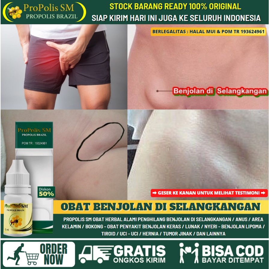 Jual Obat Benjolan Lipoma di Selangkangan 100% Herbal - Obat Penghilang  Benjolan Abnormal di Selangkangan, Salep Benjolan Lunak di Selangkangan,  Benjolan Besar  Kecil, Benjolan Berisi Nanah  Bisul, Benjolan Kelenjar  Getah