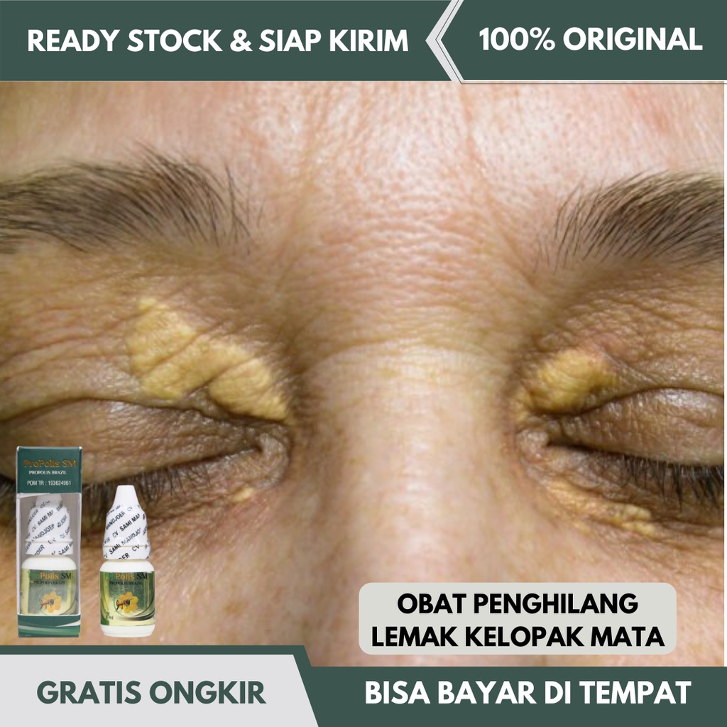 Jual Obat Penghilang Xanthelasma, Gumpalan Lemak, Plak Kuning Di ...