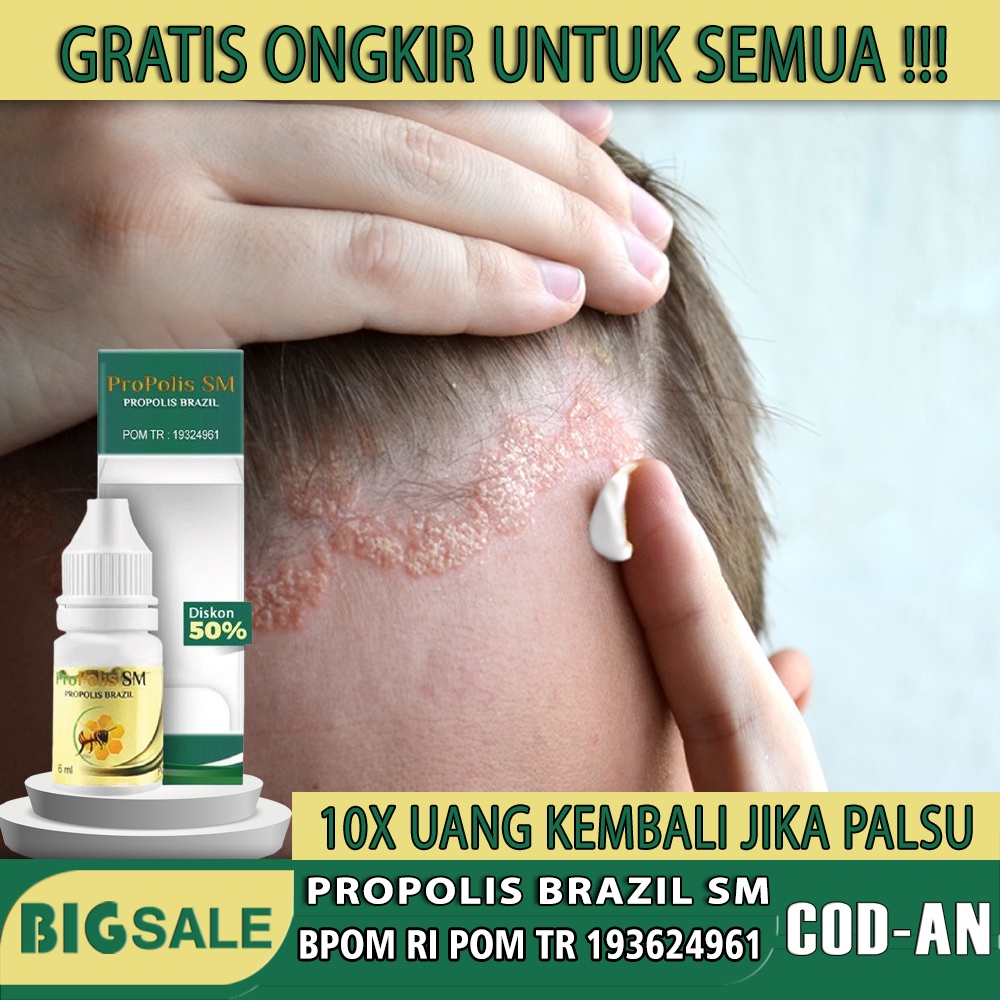 Jual Obat Psoriasis Kulit Kepala Gatal Ketombe Berkerak Kering Dan Bersisik Propolis Sm 9113