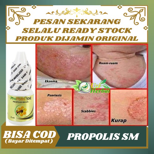 Jual Obat Herbal Gudik Gudikan Skabies Scabies Manusia Kudis Kurap