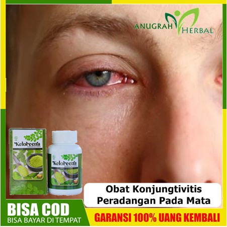 Jual Obat Konjungtivitis / Peradangan Pada Mata Untuk Anak & Dewasa ...