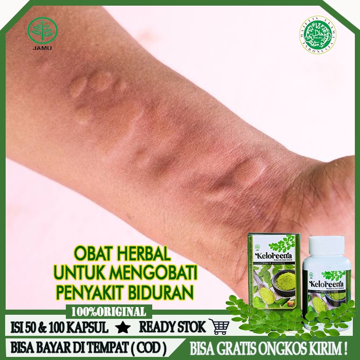 Jual Obat Biduran, Gatal - Gatal, Obat Biduran Alergi, Kaligata, Obat ...