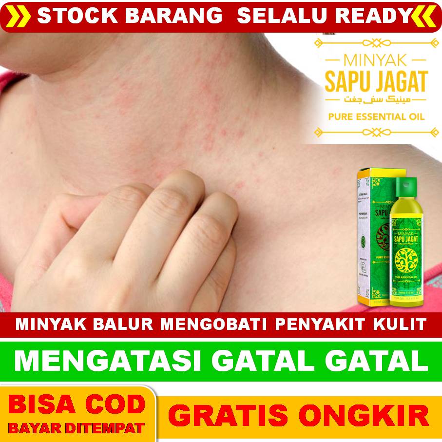 Jual Minyak Balur Gatal Gatal Di Tubuh Kaligata Biduran Alergi