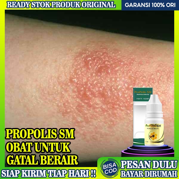 Jual Obat Gatal Berair Di Jari Tangan Dan Kaki Obat Oles Kulit Gatal Gatal Alergi Berair 6313