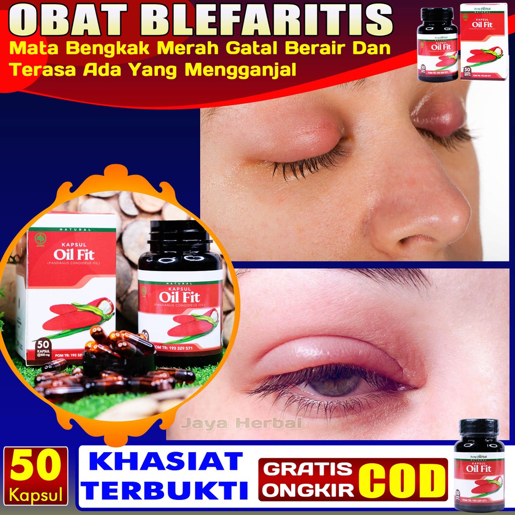 Jual Obat Blefaritis Radang Kelopak Mata, Bengkak Merah Gatal Berair