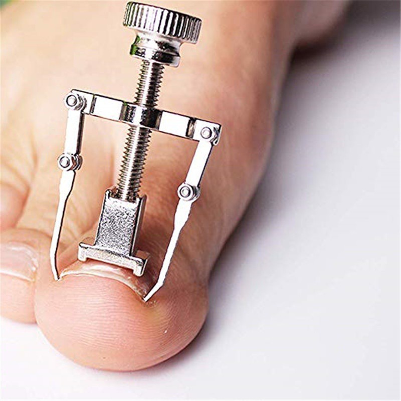 Jual Toe Nail Correction For TreatmentIngrown Nail Recover Clamp ...