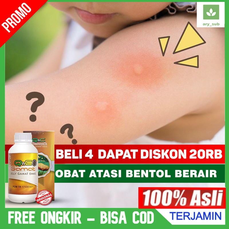 Jual Obat Bentol Berair - Bintik Berair - Biduran - Alergi - Gatal ...