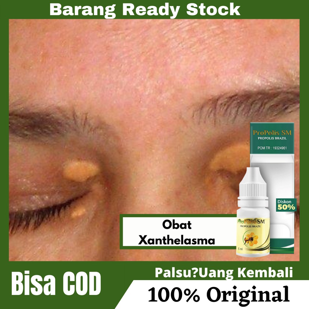 Jual Obat Xanthelasma , Plak Kuning Di Kelopak Mata , Gumpalan Lemak Di ...