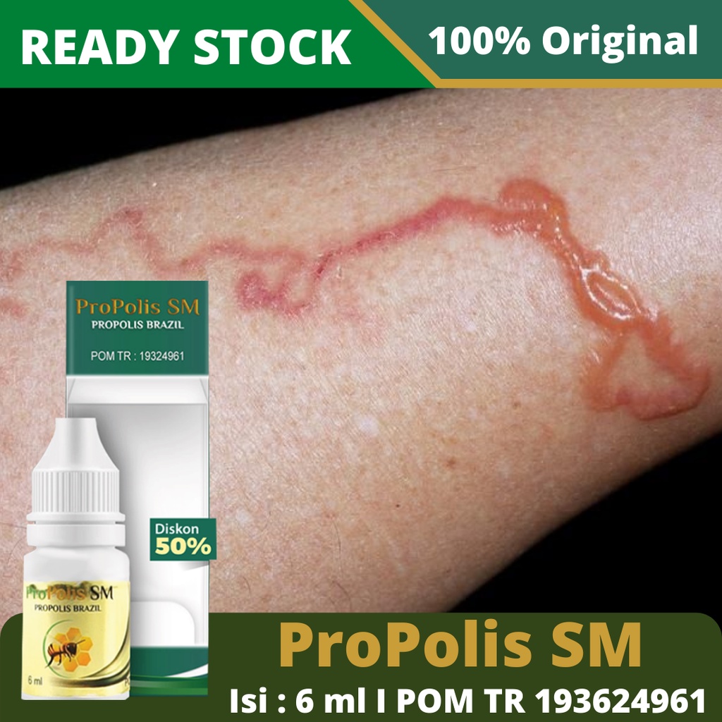 Jual Obat Cacing Pasir, Obat Cacing Pasir di Kulit, Infeksi Cacing ...