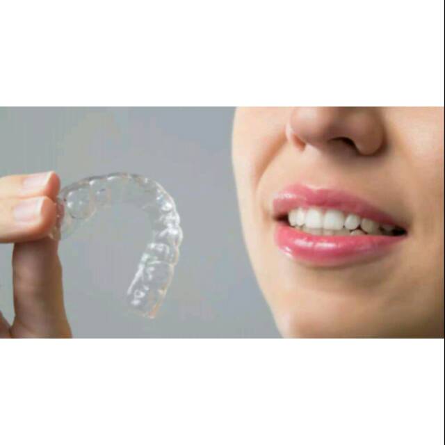 Jual RETAINER GIGI / ESSIX RETAINER | Shopee Indonesia