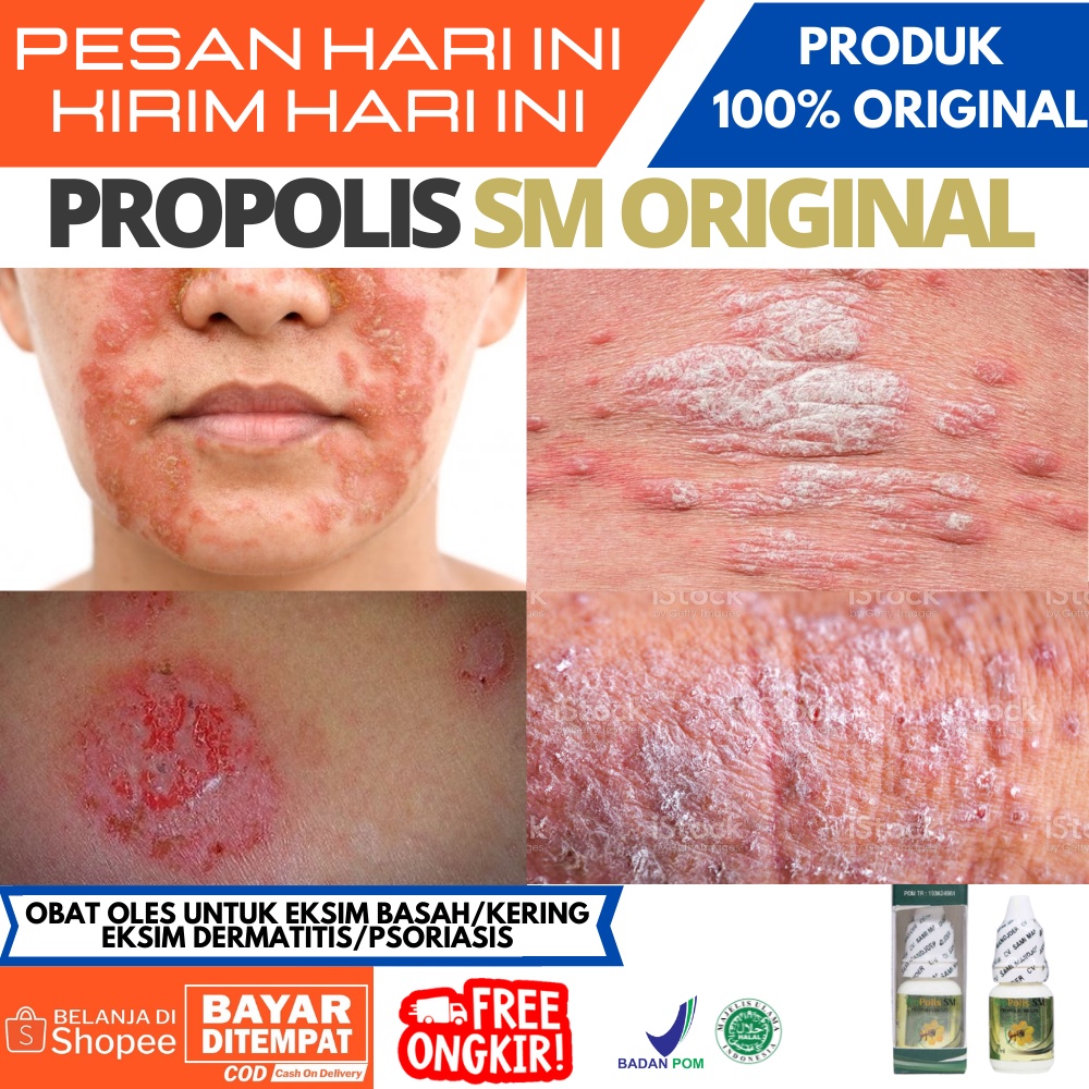 Jual Obat Eksim Basah, Kering / Eksim Dermatitis / Psoriasis / Obat ...