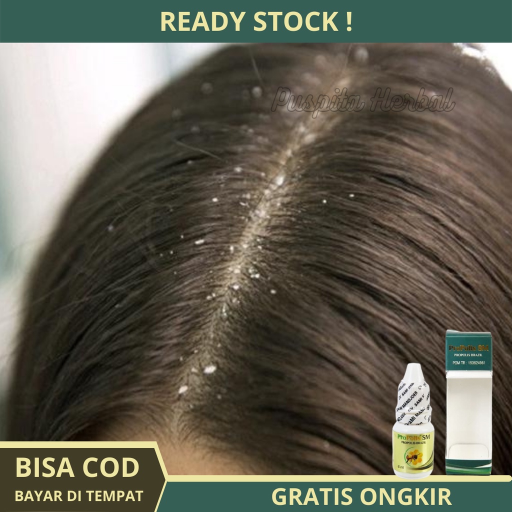 Jual Obat Herbal Tetes Ketombe Basah, Ketombe Berkerak Borok Akut Parah