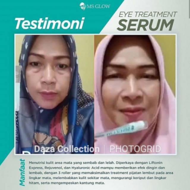 Jual EYE TRETMEN EXP 2026 SERUM MS GLOW | Shopee Indonesia