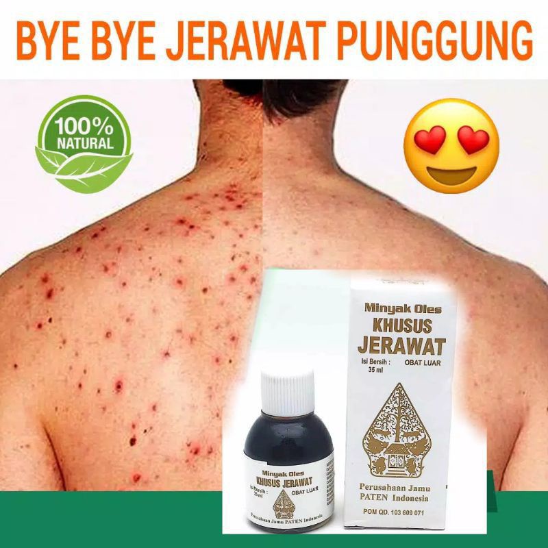 Jual Obat Jerawat Wajah Badan Punggung Pria wanita Berjerawat Serum