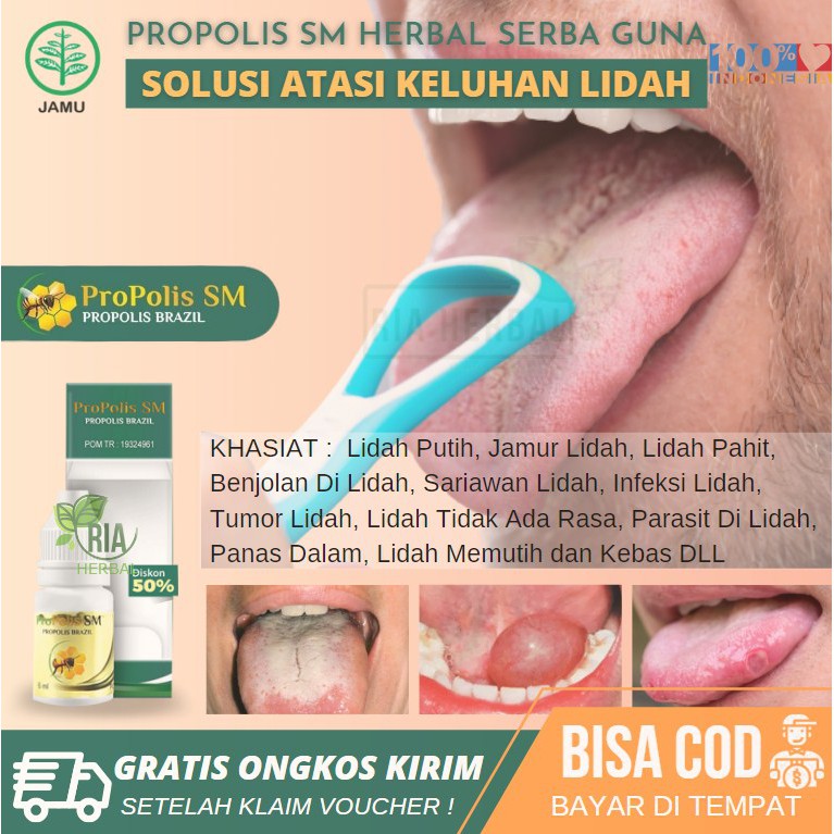 Jual Obat Tetes Benjolan Di Bibir Salep Oles Untuk Mucocele Mukokel Kista Mulut Bagian Dalam