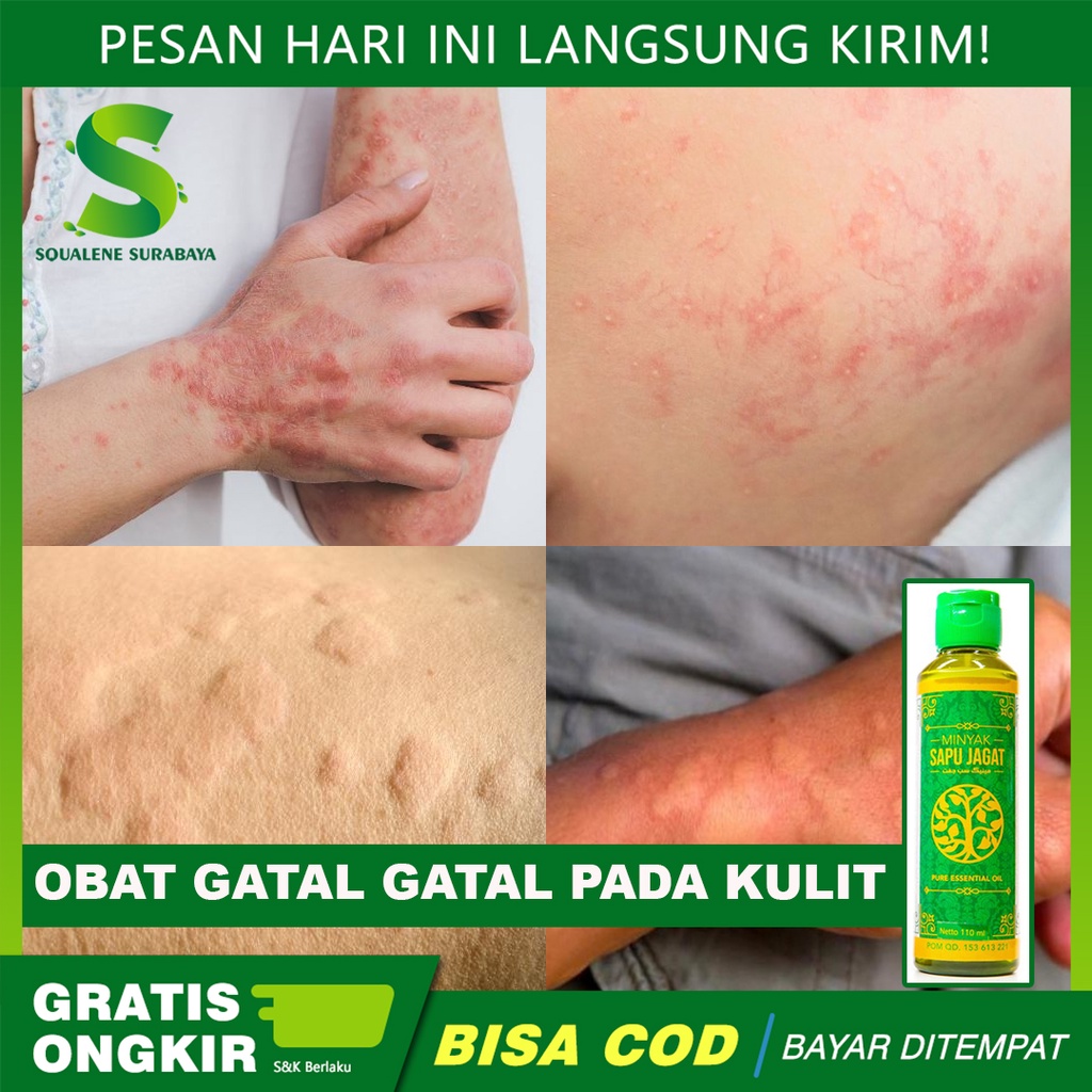 Jual Obat Gatal Gatal Pada Kulit Bintik Bintik Merah Di Kulit Alergi