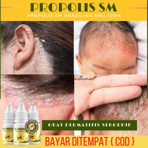 Jual Obat Dermatitis Seboroik Di kepala, Penghilang Ketombe parah