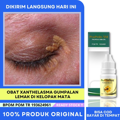 Jual Obat Xanthelasma Menghilang Penghilang Gumpalan Lemak Di Kelopak ...