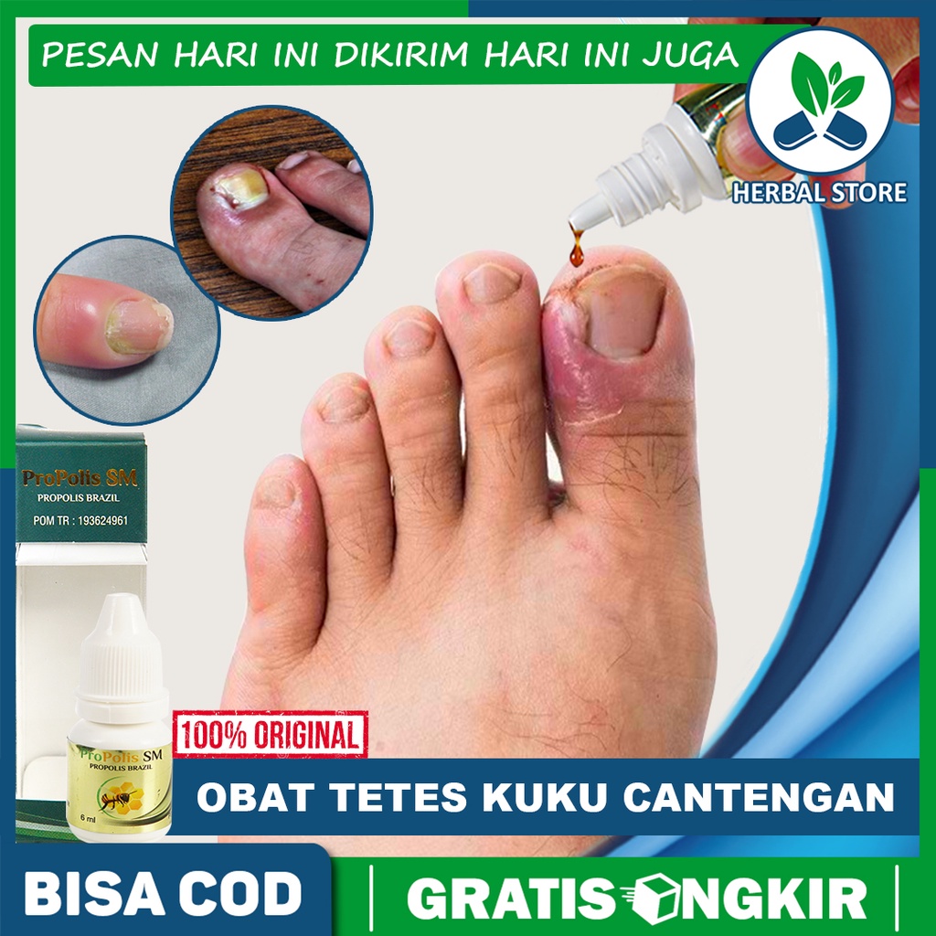 Jual Obat Herbal Cantengan Kaki Dan Tangan Infeksi Kuku Busuk Rusak