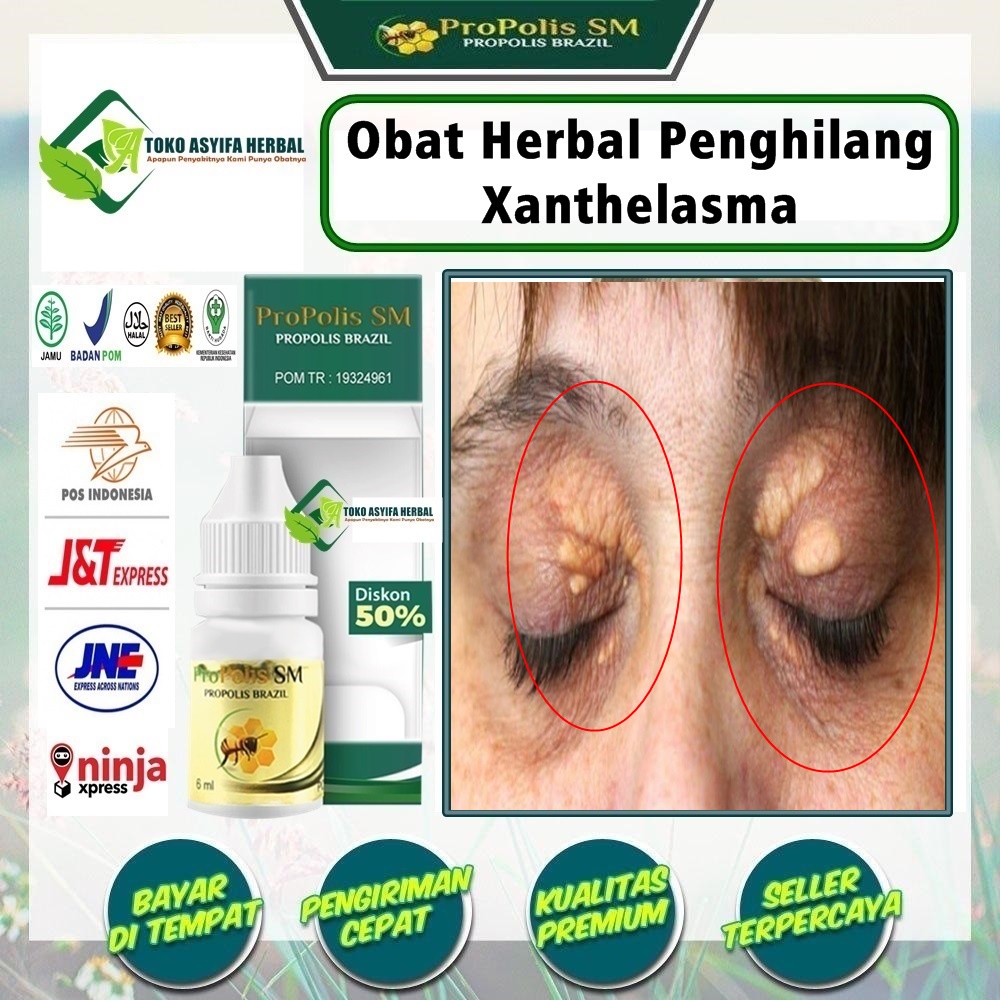 Jual Obat Untuk Hilangkan Lemak Di Kelopak Mata Dengan PROPOLIS SM Obat ...