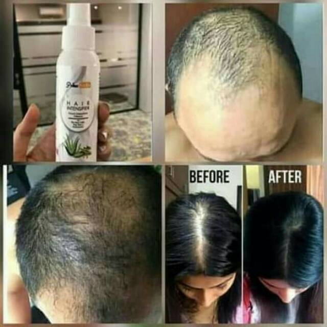 Penumbuh & Perawatan Rambut Rontok Everspring Original Tanpa Bahan Kimia  Bonus Alat Pakai