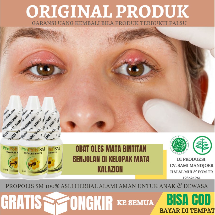 Jual 100% Alami Obat Oles Benjolan Bengkak Di Kelopak Mata, Mata Bintit ...