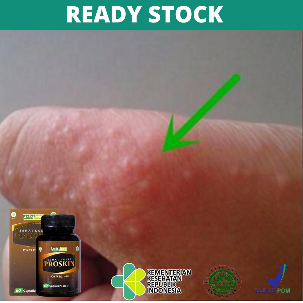 Jual Obat Gatal Berair di Tangan, Bintik Berair di Telapak Tangan ...
