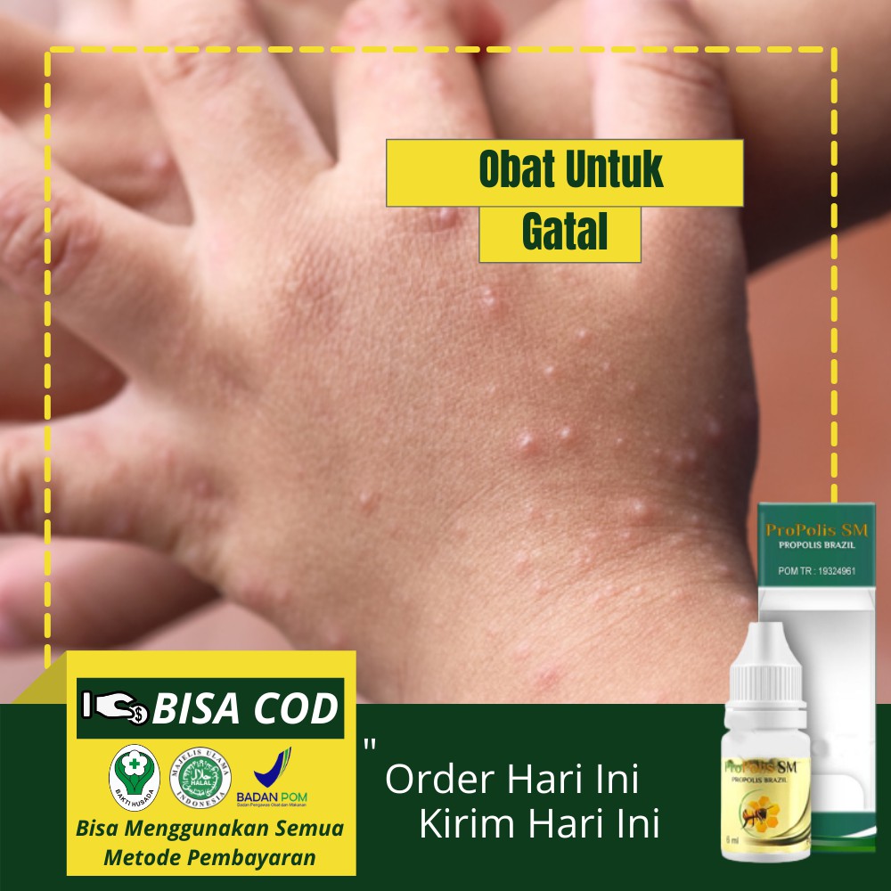 Jual Obat Bintik Berair Di Tangan Penyakit Kulit Bintik Telapak