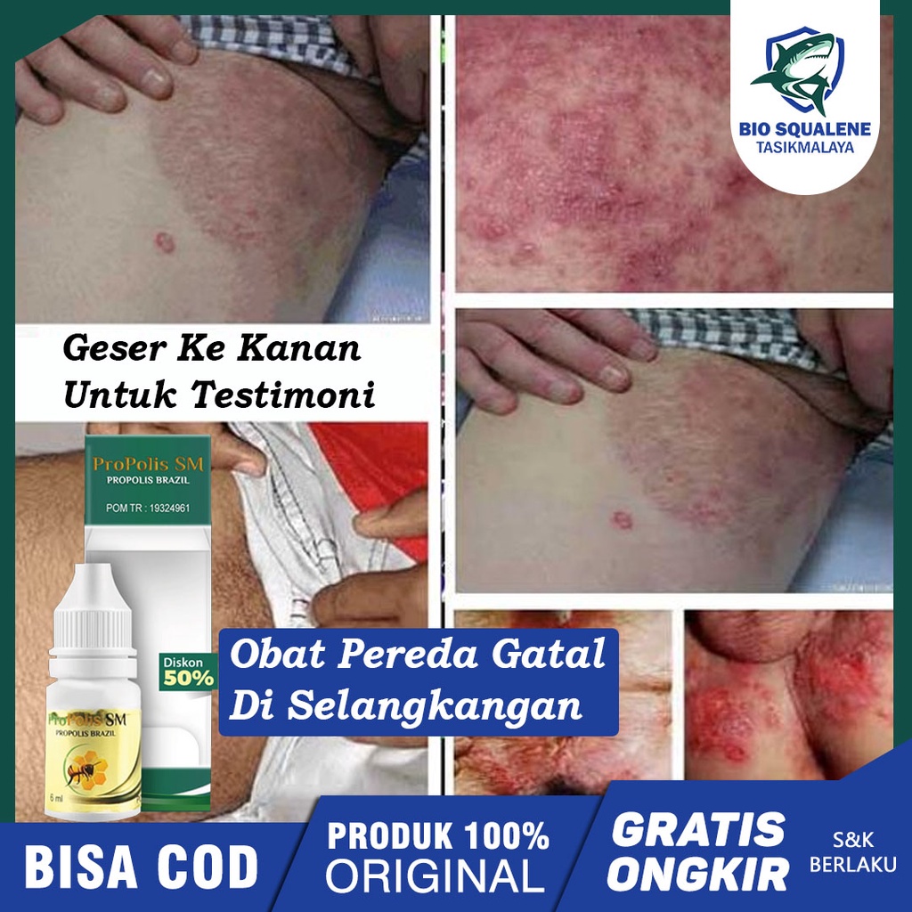 Jual Obat Gatal Di Selangkangan, Kulit Lecet Menghitam, Infeksi Kulit