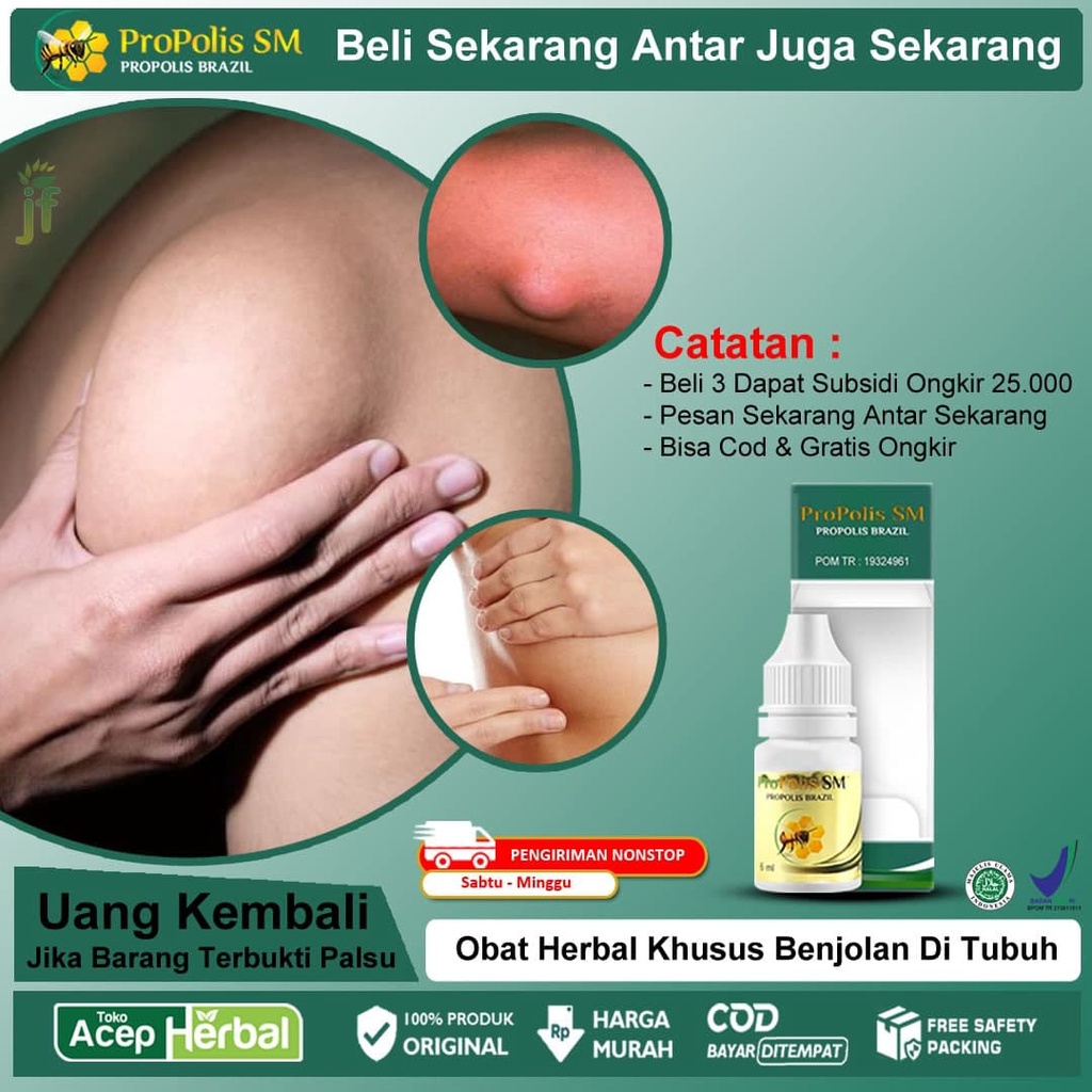 Jual Obat Benjolan Di Tubuh Benjolan Uci Uci Kelenjar Getah Bening