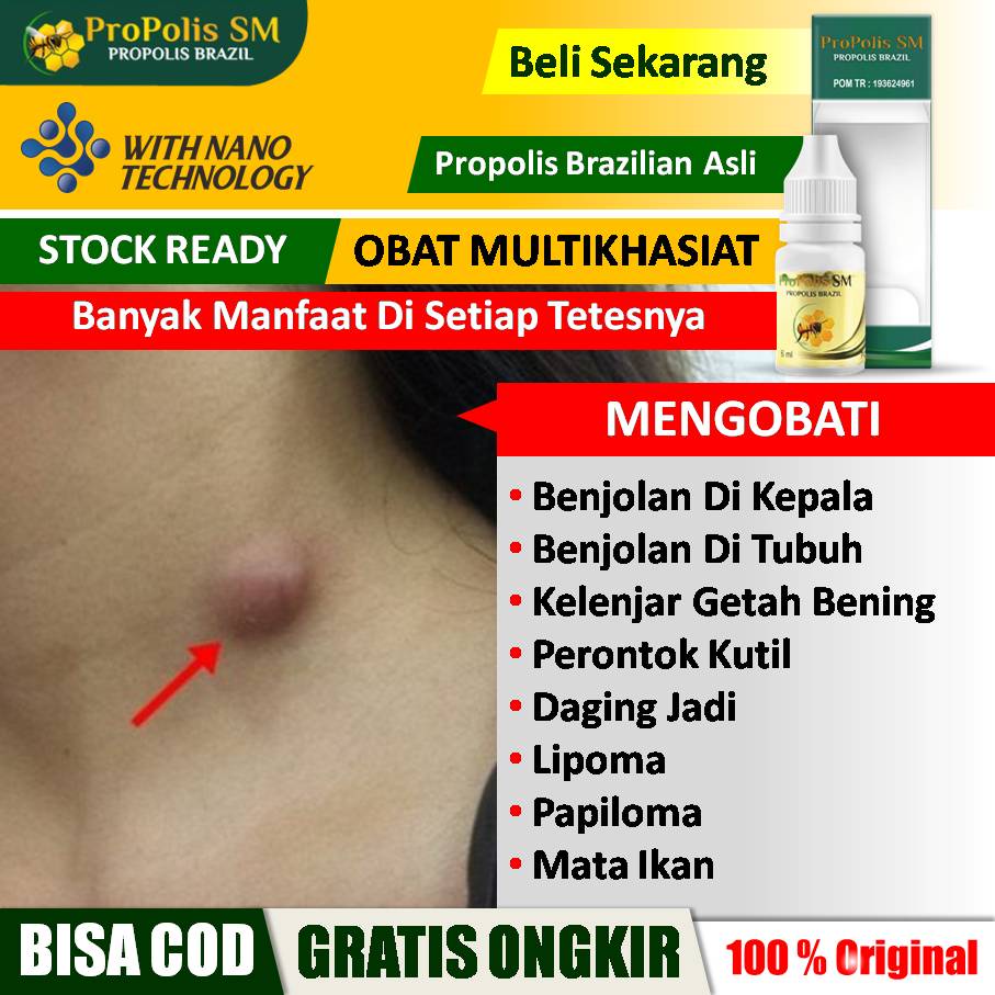 Jual Obat Benjolan, Benjolan Di Tubuh, Benjolan Di Kepala, Benjolan Di ...