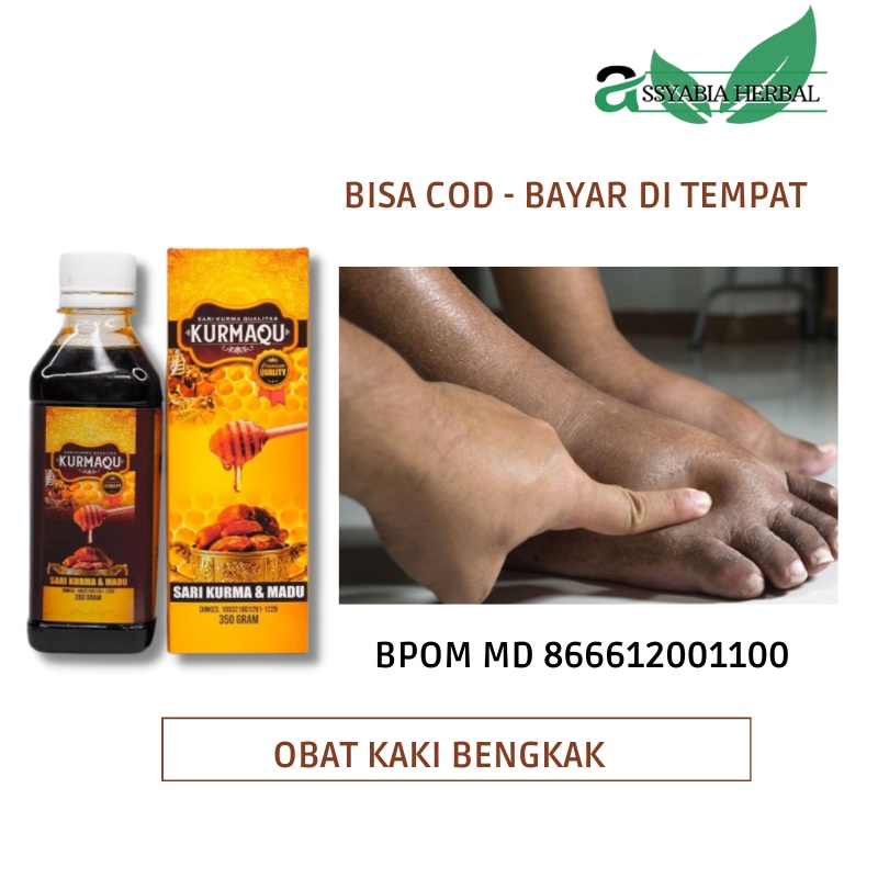 Jual Obat Pengempis Kaki Bengkak, Obat Kaki Bengkak Karena Diabetes