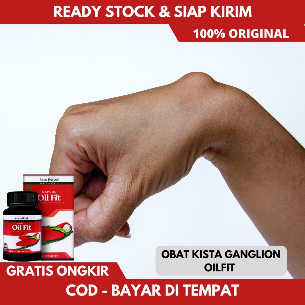 Jual Obat Kista Ganglion, Obat Benjolan Ganglion, Obat Benjolan Di ...