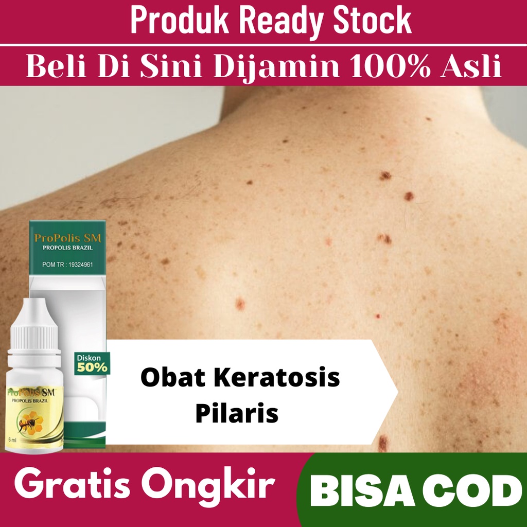 Jual Obat Keratosis Pilaris Bruntusan Di Kepala Bayi Bintik Bintik Kecil Di Kulit Propolis