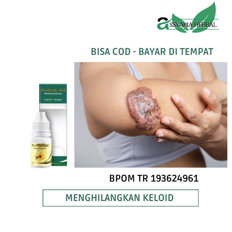 Jual Propolis Sm Obat Untuk Menghilangkan Keloid Daging Tumbuh Daging