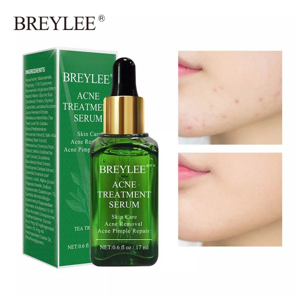 Jual BREYLEE Acne Serum Treatment - Wajah Berjerawat (17ml) | Shopee