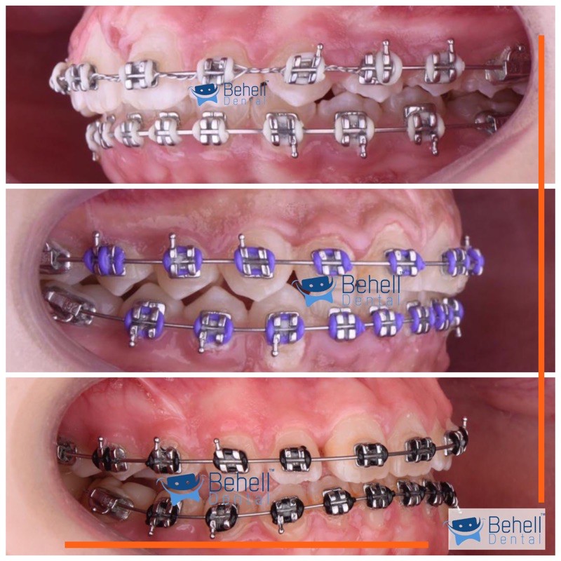 Jual PAKET BEHEL PERMANEN METAL ORTHO BRACKET ORTHO CLASSIC USA ROTH ...