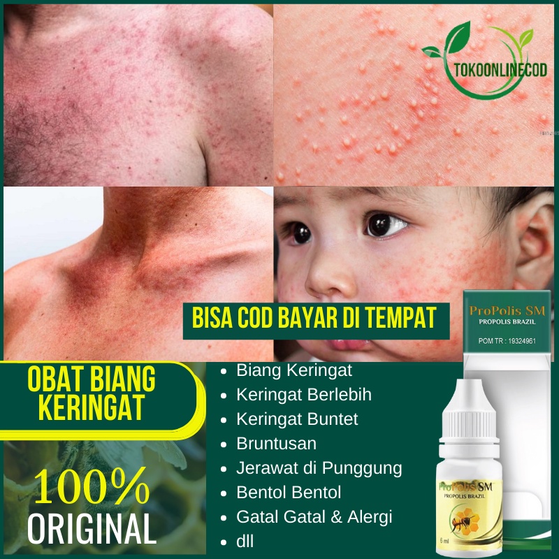 Jual Obat Oles Penghilang Biang Keringat Keringat Berlebih Keringat