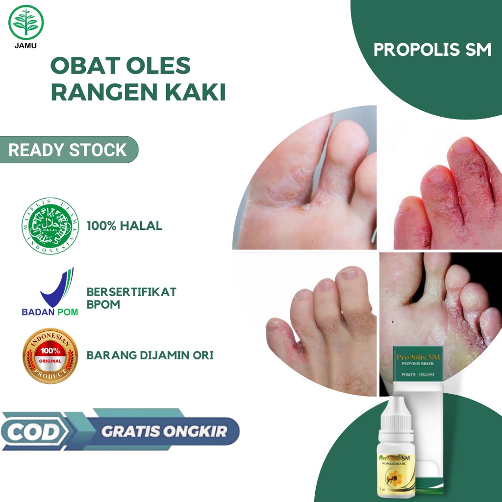 Jual Obat Rangen Kaki, Obat Gatal Gatal Kaki, Kutu Air di Kaki, Obat ...