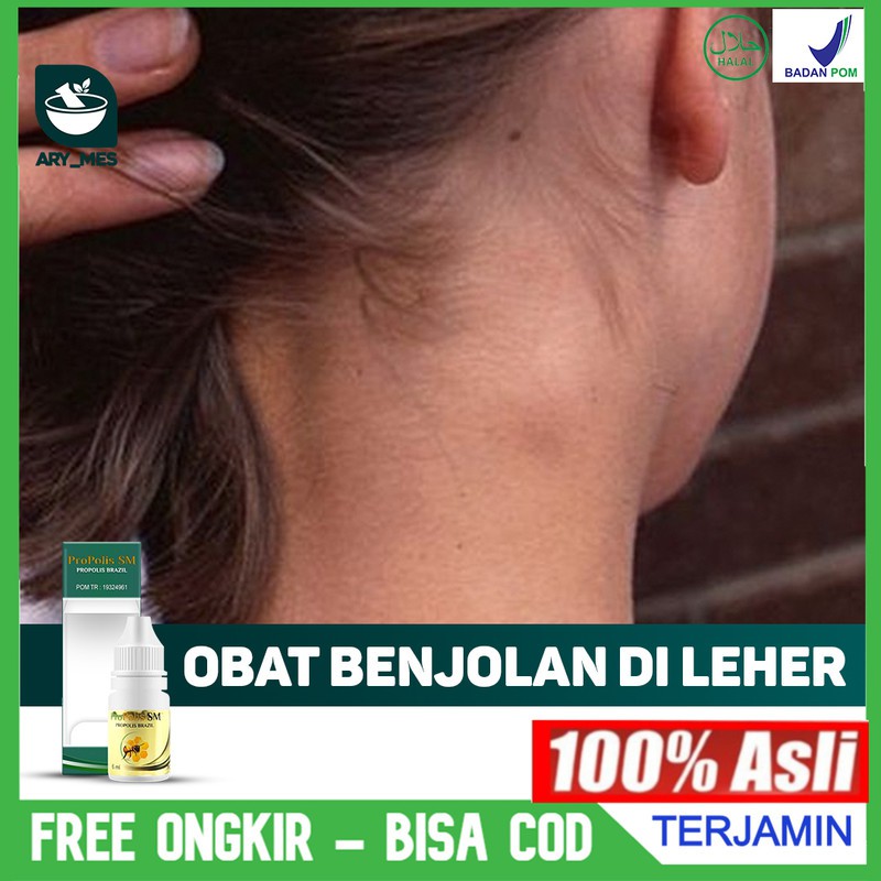 Jual Obat Benjolan Di Leher - Kelenjar Getah Bening - Obat Benjolan Di